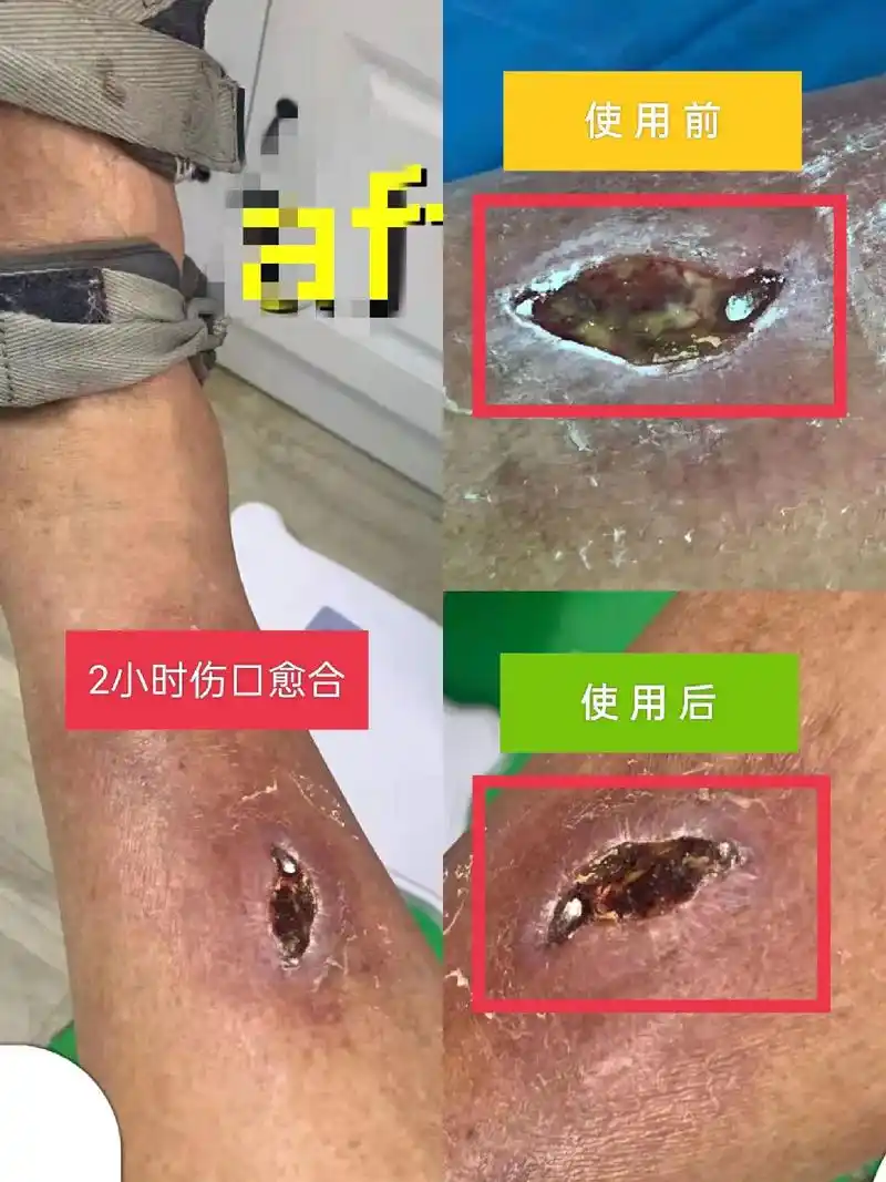 吹吹就能把伤口吹好