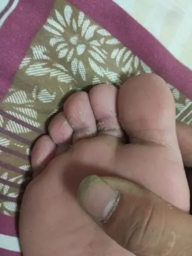 脚趾头褪皮是脚气引起的吗