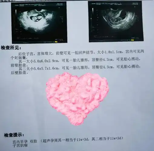 双胎11周3天了已经有胎盘了
