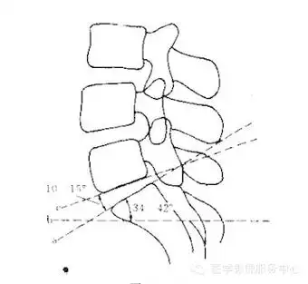 此外腰骶角的存在,对判断腰骶椎分界具有一定价值,不过存在水平骶椎是