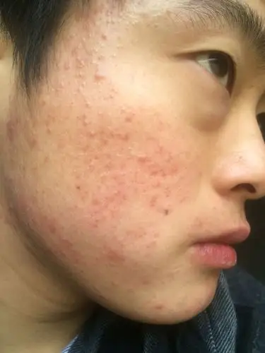 原先脸上有青春痘,好了以后面部泛红,而且皮肤上面有小点!是什么原因