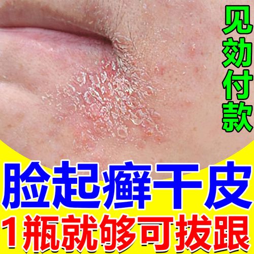 男士脸上起癣长癣眼皮癣脸部皮肤干燥起皮有碎屑除过敏红痒癣修复