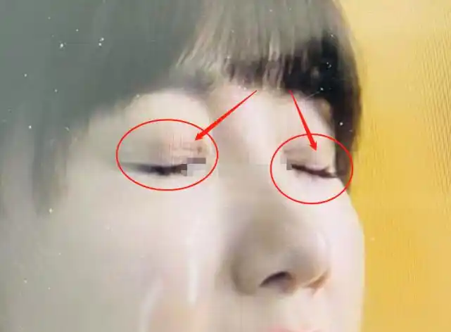 还吐槽毛晓彤的双眼皮和眼角开的很随意,感觉疤痕增生很不容易好