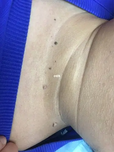 丝状疣的危害主要表现与三个方面:1,丝状疣有碍观瞻丝状疣危害女性