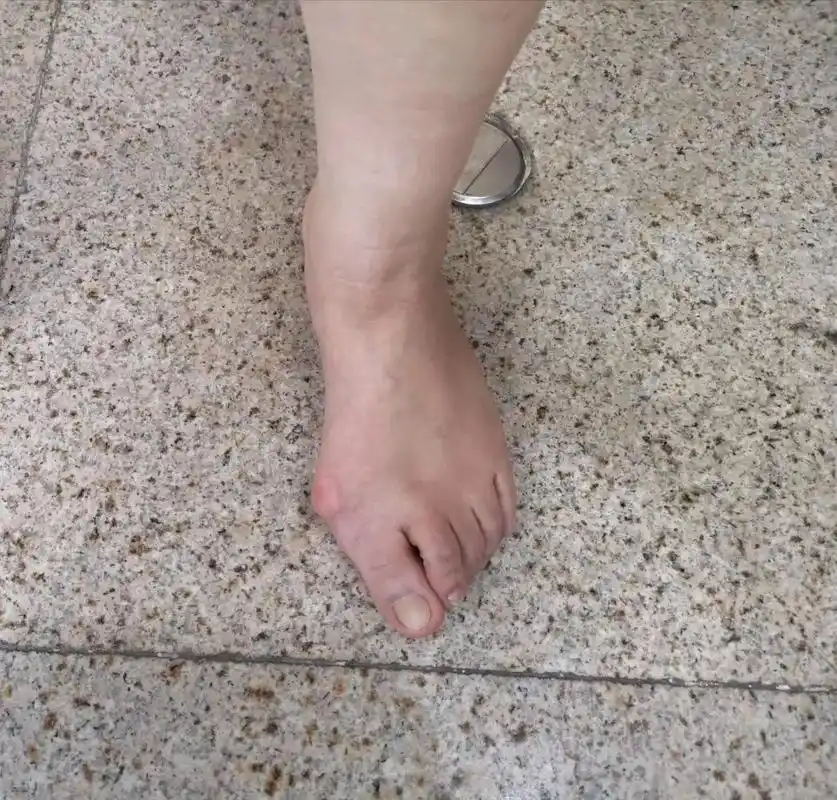 拇外翻也称大脚骨,好发于女性,有的会严重影响功能和美观,山西 - 抖音