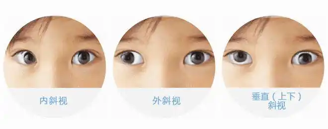 儿童斜视要矫正吗?听眼科专家怎么说!|弱视|手术_网易订阅