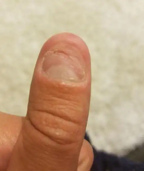 咬指甲有什么危害我们需要怎样纠正孩子咬指甲