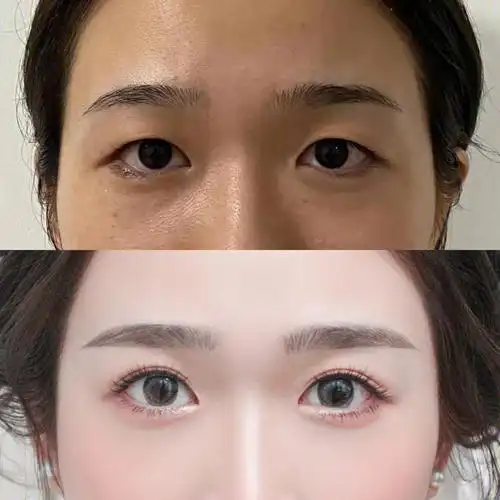 单眼皮vs双眼皮