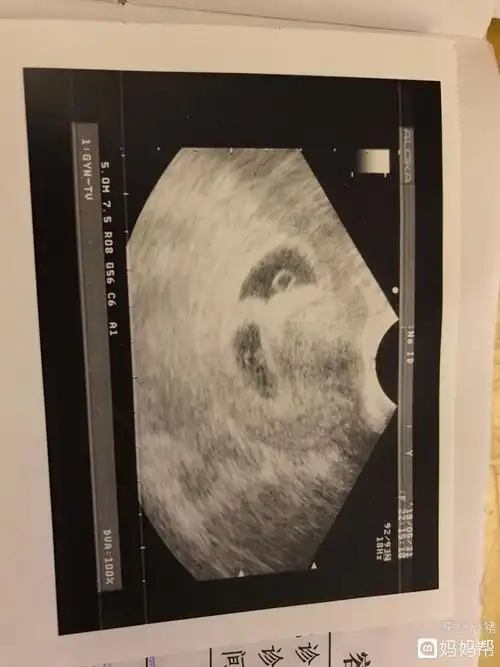 宝宝有胎心胎芽了