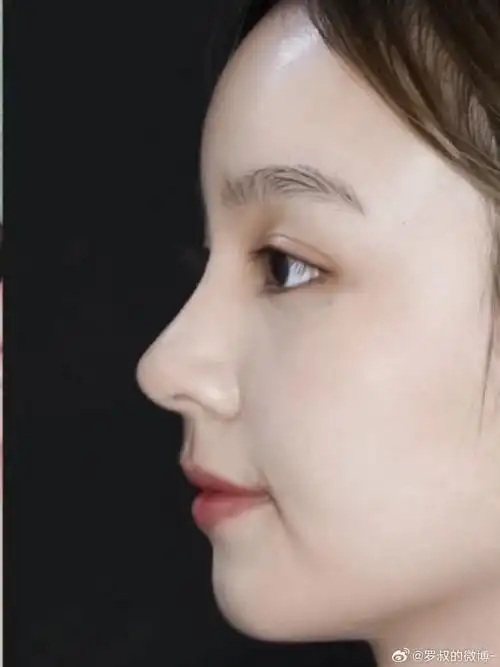 终于可以自信拍侧脸了8715术前问题今天这位宝子的原生鼻整体较塌