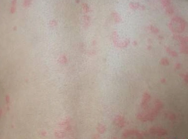 湿疹与荨麻疹的区别有哪些 湿疹有哪些症状表现呢