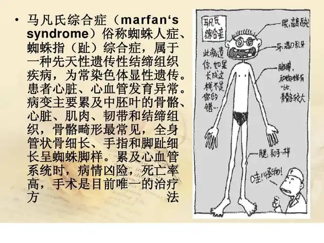 马凡氏综合症护理查房ppt