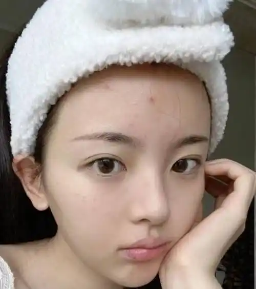 杨超越晒素颜照,脸上痘痘脂肪粒明显,配文:我就当是一种风格了!