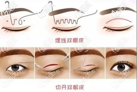 埋线双眼皮和切开双眼皮的对比差别