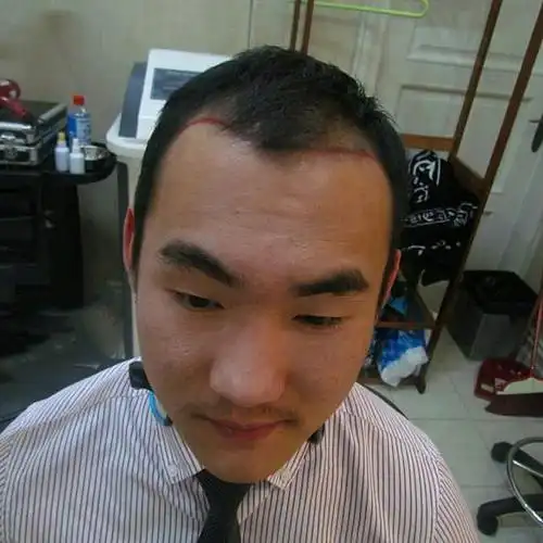 天生的m发际线,发型基本都是刘海,几十年了,感觉被_圈子-新氧美容整形