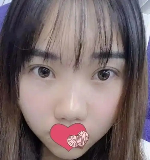 王馨婉医生做的7mm小平行双眼皮恢复3个月后,效果很自然