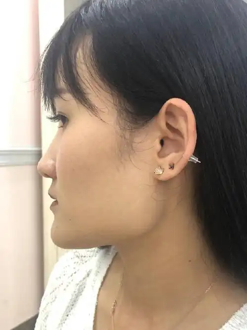 之前下颌角那里突出一块很明显,看起来就很突兀,不仅_圈子-新氧美容