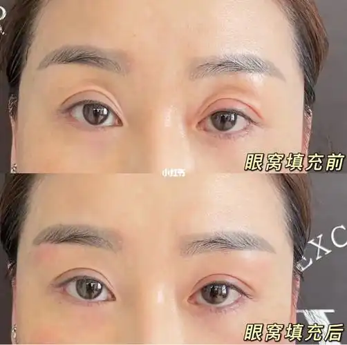 vran唯然医美眼窝凹陷填充随着年龄增长