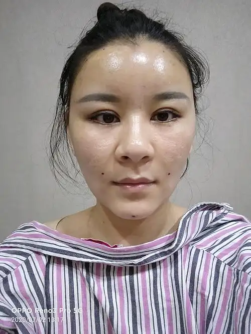 全脸填充第21天,脸真的越来越自然,自身体会希望大_圈子-新氧美容整形