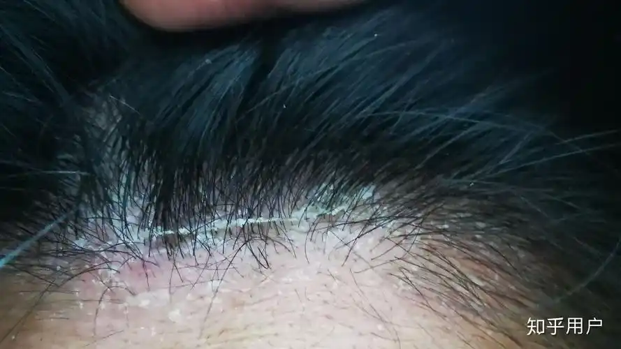 见过的最大头皮屑多大