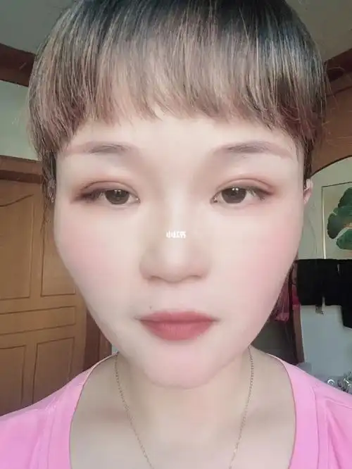 埋线双眼皮恢复