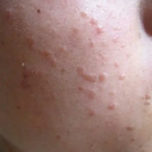 脚部扁平疣症状图片