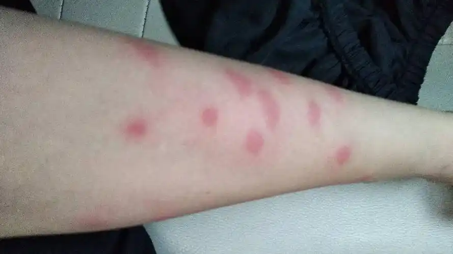 手臂上长了很多包包,像蚊子咬的,怎么治疗?