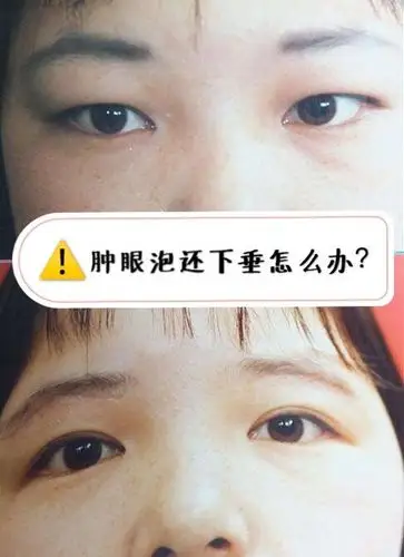 上眼睑脂肪厚,也叫做眶隔脂肪肥厚.