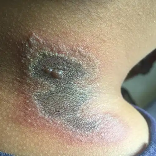 脖子后长了一片红红的有水泡,麻麻的碰了会痛但不痒,是什么?用什么