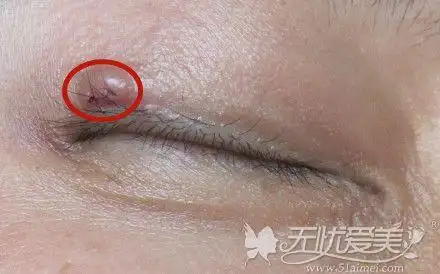 埋线双眼皮线头线结反应