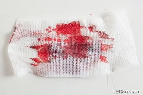 女性下边流出这种血可能是宫颈癌赶紧检查下hpv