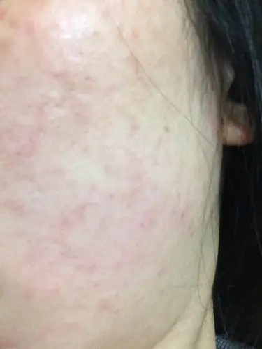 脸部过敏好几个月了看了好多医生也没治_有问必答_快速问医生