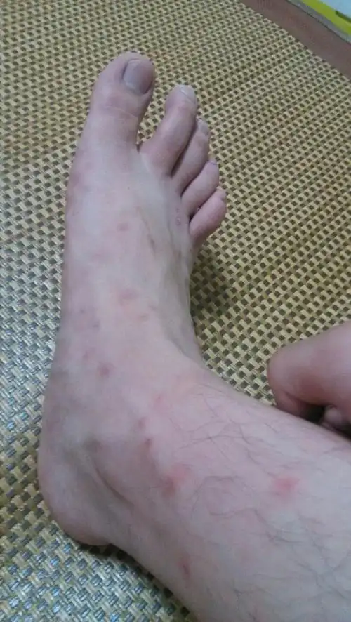 前几天在外面吃烧烤,被蚊子咬的脚上到处都是包怎么办?