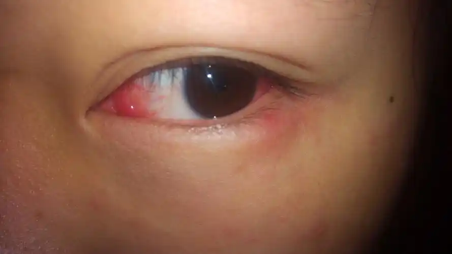 最近眼睛里突然有红血丝会发痒喜欢揉不怕光也不疼眼睛右下角