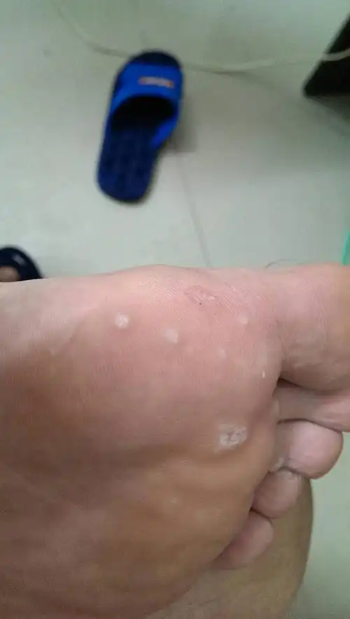 我脚上长的什么东西 ,不痛不痒,用剪刀弄掉了,又自己长出来.