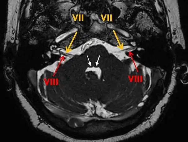 该病典型的 mri 表现为双侧面神经发育不全,在平衡稳态梯度回波序列