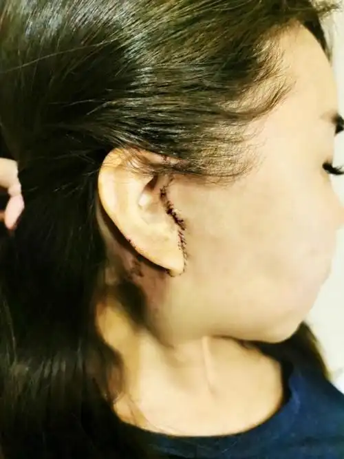 做迷你拉皮一个月就恢复的无痕了,所以我才下定决心来做这个手术的