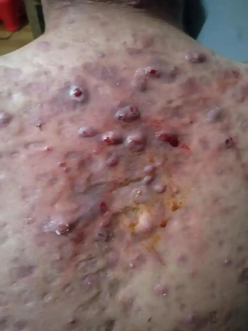 毛囊炎有多么的严重!家人们我每 - 抖音