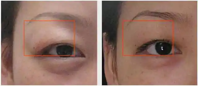 《水肿对应疾病自查表》,这4种人一定要收藏!