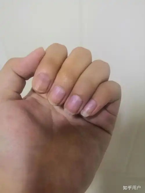 指甲发紫怎么回事? - 知乎