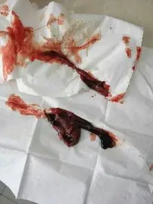 50天自然流产孕囊图片 - 搜狗图片搜索