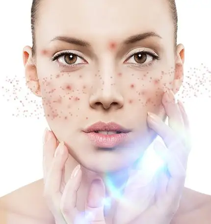 皮肤 祛疤祛痘 祛痘 二,吴氏嘉美激光 祛痘印的优势:    1.