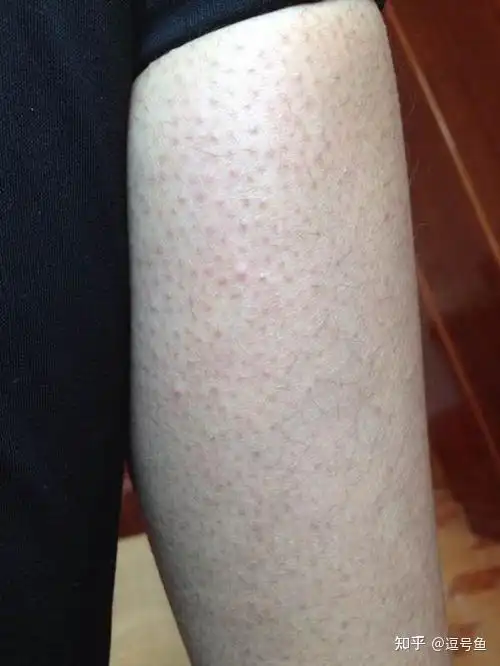 可以明显缓解鸡皮肤引起的皮肤粗糙症状,可以溶解局部的毛囊