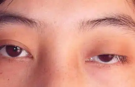 上眼皮下垂,睁不开眼睛是什么原因?双眼皮眼肌无力怎么矫正?