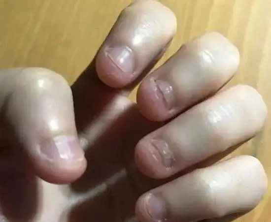 优家说孩子爱咬指甲是缺维生素吗