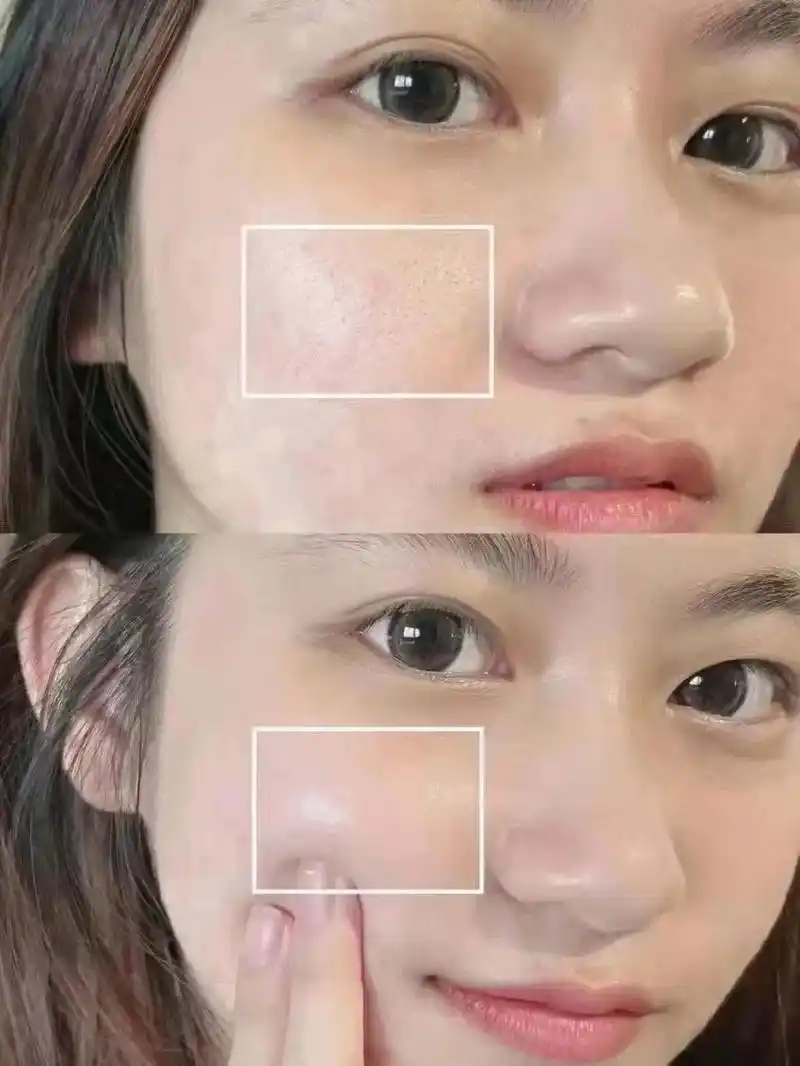 水光针前后对比.#拯救痘痘肌 #护肤 #美白淡斑 - 抖音