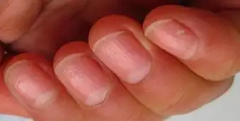 病情分析:您好,指甲上有横纹,可能是有心脏病,机体缺钙,贫血或营养