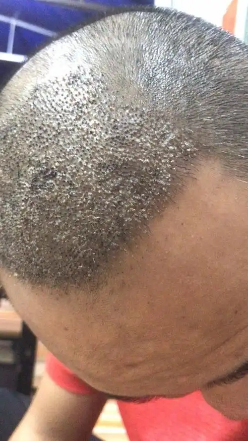 看我这头发移植区还没有清洗干净血痂,看着好恶心