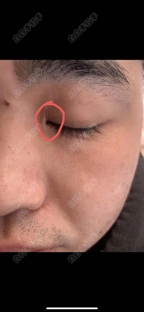 本人身上有白白,发现眼角处有点白,帮我看看,担心扩散在脸上!