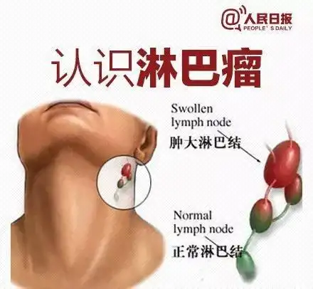 【9·15世界淋巴瘤日】淋巴瘤,可以滚蛋的肿瘤君